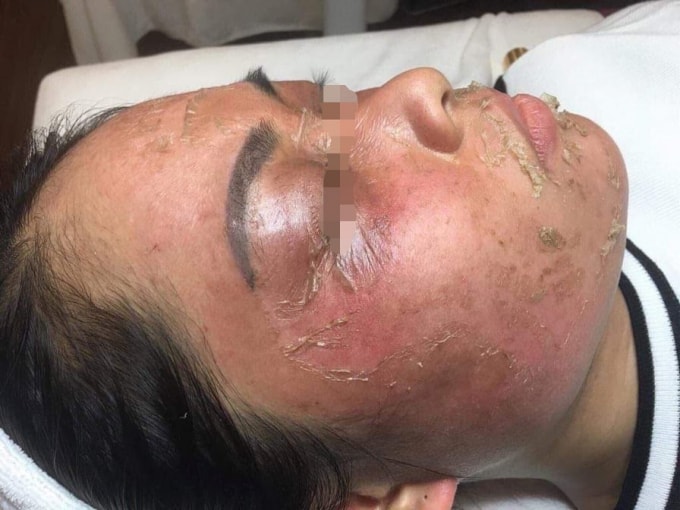 Chị T. cho biết, da mặt nhiều khách hàng của Spa bị hư tốn nặng do sử dụng mỹ phẩm mà Công ty Linh Ngân phân phối (Ảnh:NVCC).