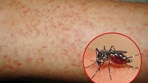 Bộ Y tế: Báo động sốt xuất huyết đang không ngừng gia tăng. Ảnh minh họa
