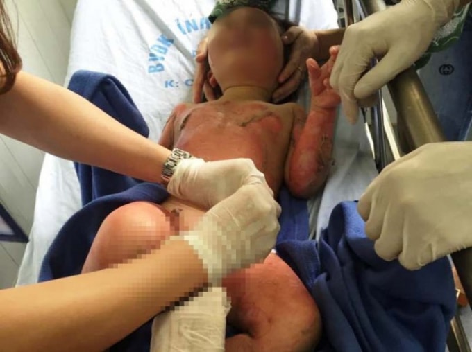 1 cháu bé bị bỏng được bác sĩ ở Bệnh viện Đa khoa tỉnh Hà Nam cấp cứu. Ảnh: TT