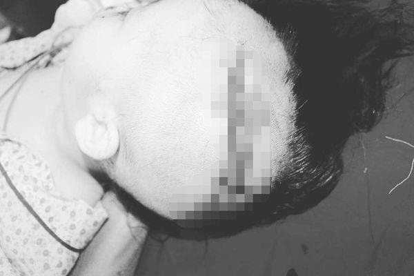 Bệnh nhi 2 tuổi ở Hà Nội bị chó cắn rách đầu nhập viện tại bệnh viện Xanh Pôn. Ảnh: Bệnh viện cung cấp.