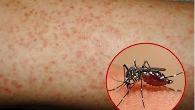 Tác nhân trung gian truyền bệnh sốt xuất huyết là các loại muỗi