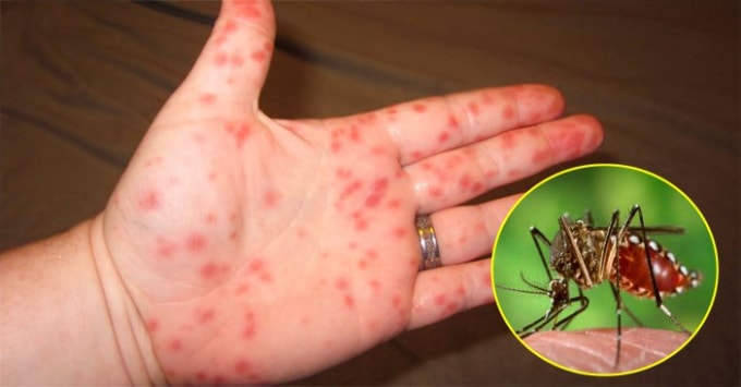 Sốt xuất huyết là loại bệnh nguy hiểm lây truyền từ muỗi