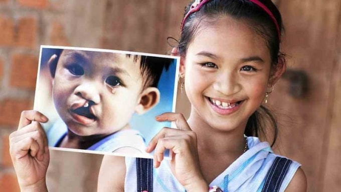 Một bệnh nhi đã được phẫu thuật miễn phí bởi Operation Smile. Ảnh: Operation Smile