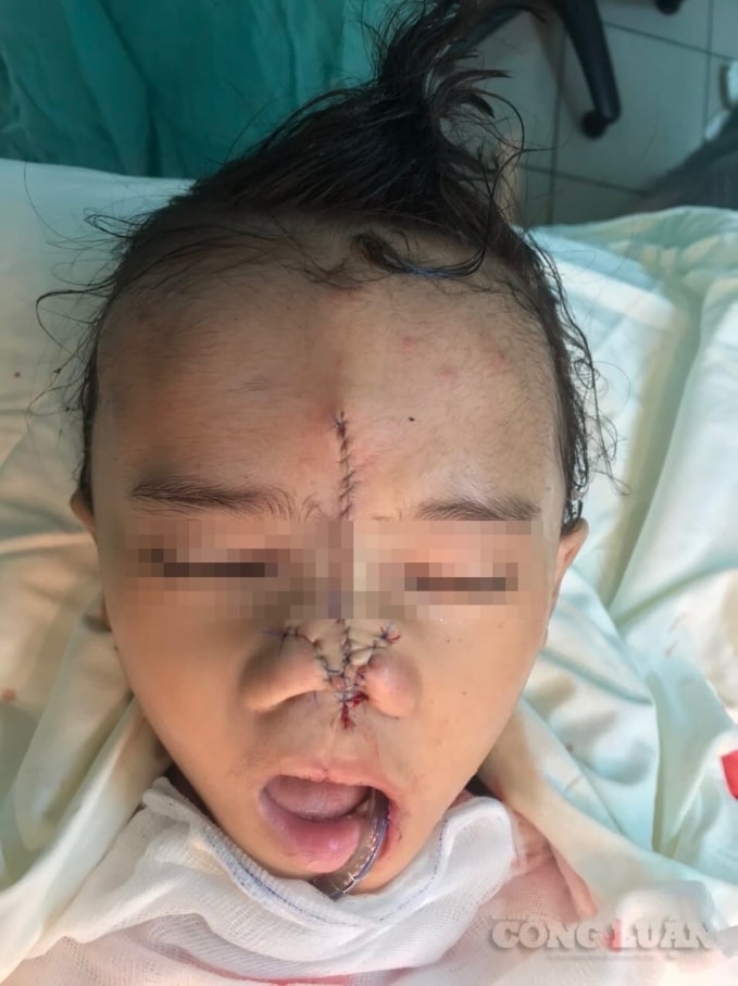 Cháu P. vừa được các bác sĩ phẫu thuật.