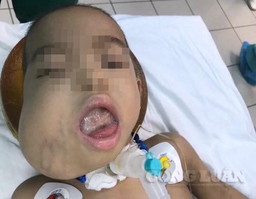 Bệnh nhi N mang khối u quái hỗn hợp vùng mặt trước khi mổ.