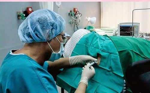 Biện pháp gây mê tủy sống giảm đau trong mổ lấy thai. Ảnh minh họa