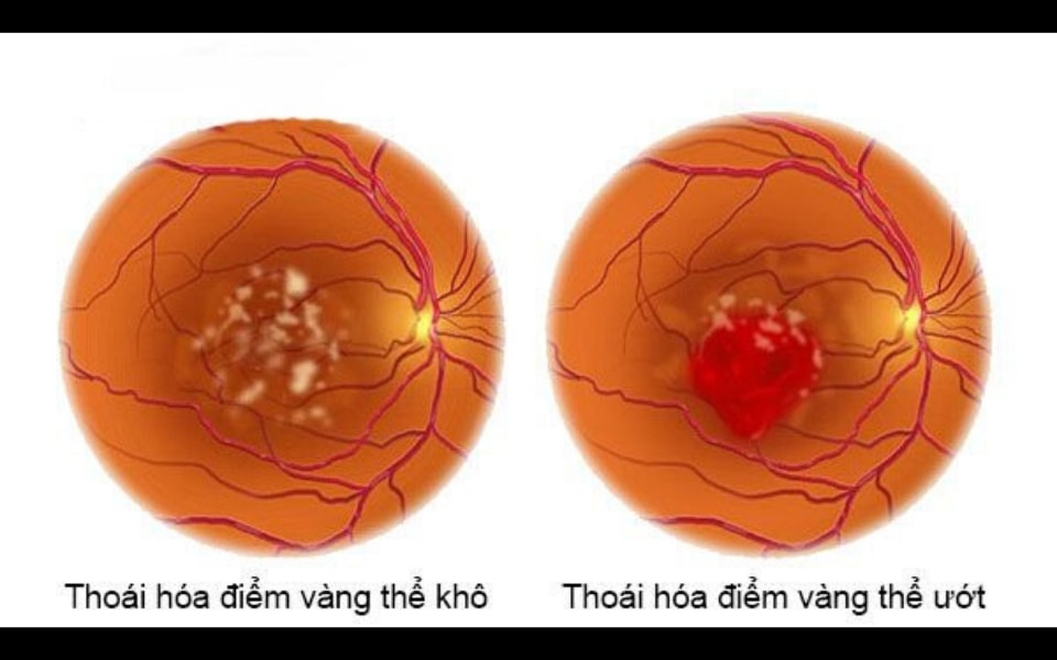 Có hai loại thoái hóa điểm vàng là thoái hóa điểm vàng thể khô và thoái hóa điểm vàng thể ướt.