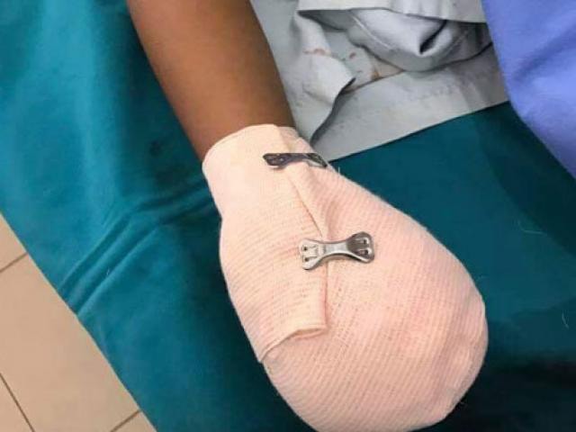 Điện thoại phát nổ khi sạc, nam thanh niên dập nát bàn tay. Ảnh: TL