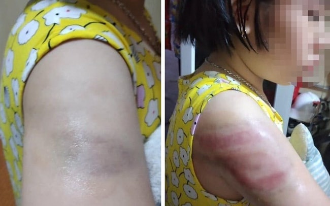Vết bầm tím trên cánh tay em học sinh. Ảnh: gia đình cung cấp