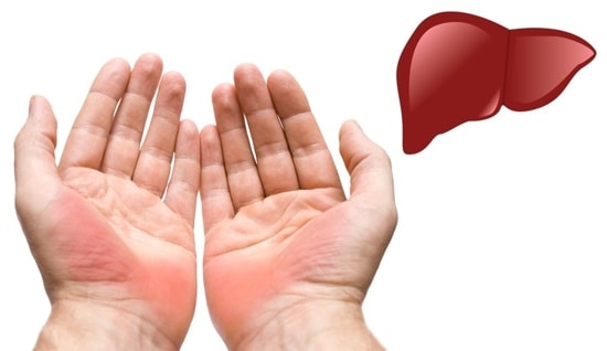 Một trong những dấu hiệu đầu tiên về ung thư gan đó là trên lòng bàn tay xuất hiện màu đỏ ửng hoặc thậm chí nổi ban đỏ