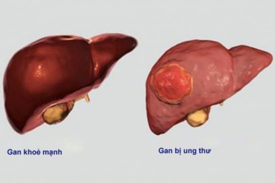 Sự sạm đen của da mặt cho thấy có thể có dấu hiệu của ung thư gan