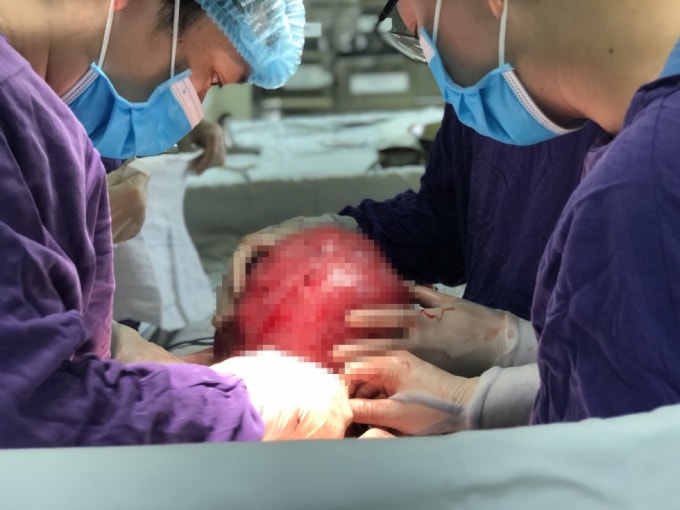 Kíp phẫu thuật hoàn thành việc đưa khối u ra khỏi cơ thể chị C. (ảnh TL).