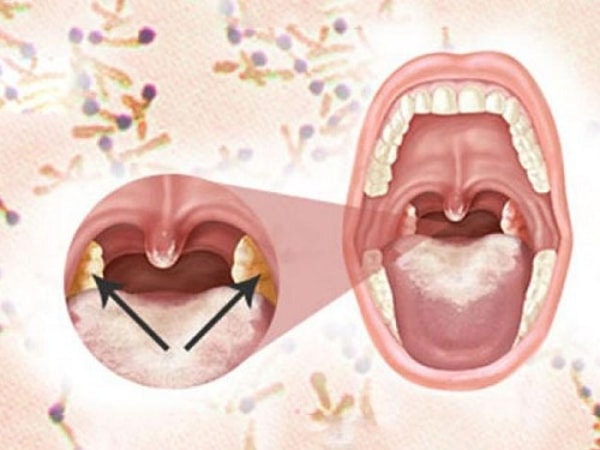 Vi khuẩn bạch hầu tạo thành lớp giả mạc màu trắng xanh, dai và dính chắc vào amiđan, hoặc có thể lan rộng bao phủ cả vùng hầu họng