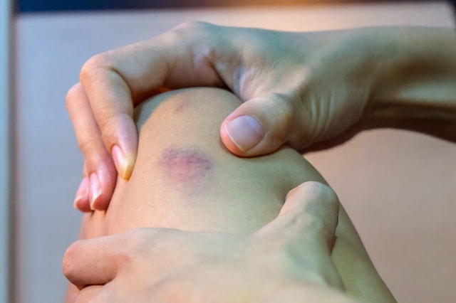 Một dấu hiệu quan trọng và dễ bị bỏ qua của lão hóa sớm đó chính là dễ bị bầm tím.