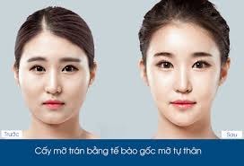 cấy mỡ tự thân
