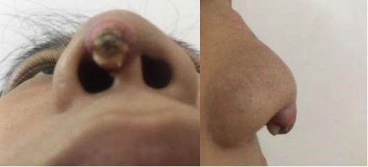 Mũi bị biến dạng, nhiễm trùng như mọc thêm một phần thịt thừa đáng sợ.