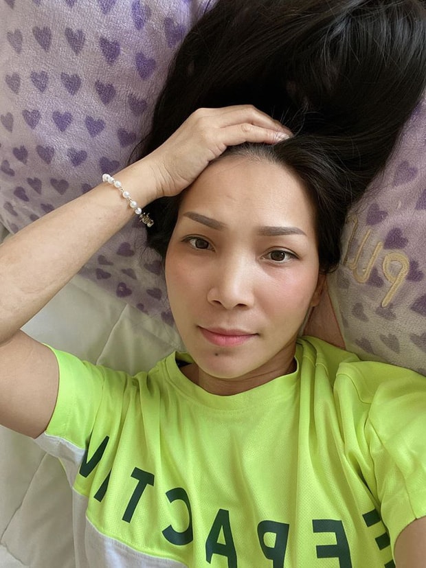 Một số vết bỏng nặng trên cánh tay vẫn còn. Ảnh: TL.