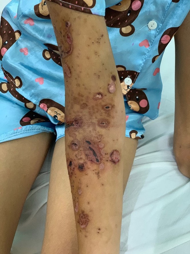 Vết thương đóng vảy sau khi điều trị tích cực. Ảnh: TL.