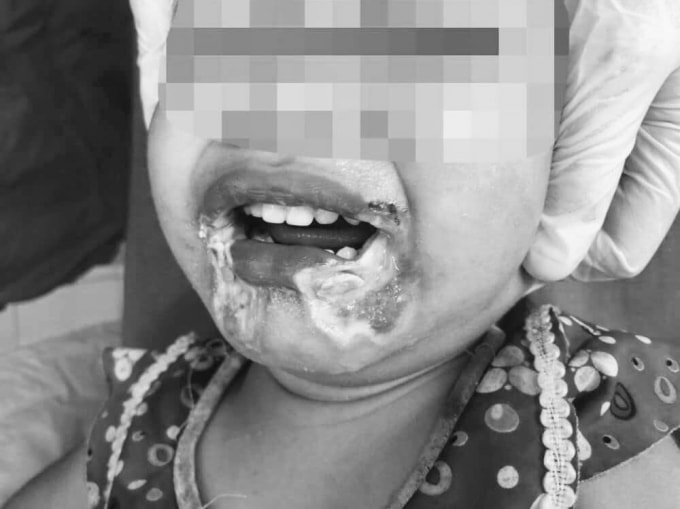 Bé gái 2 tuổi hoại tử miệng vì cắn phải dây điện. Ảnh: TL.