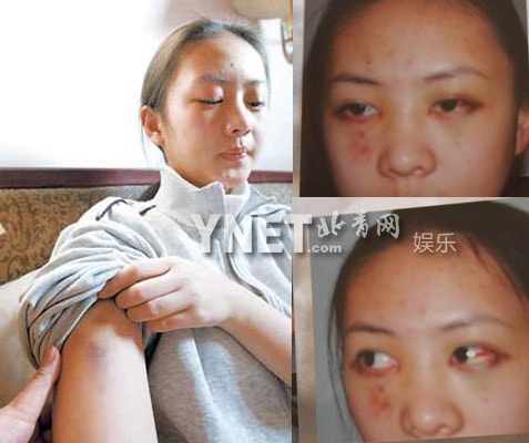 Đồng Dao bị đánh gãy mũi, mắt trái bị xuất huyết làm thị lực giảm 0,6%, và có nhiều vết bầm tím khắp cơ thể.