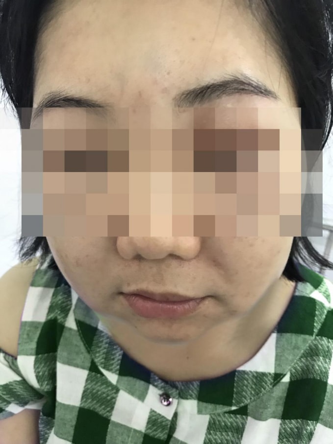 Thời gian qua, khoa Thẩm mỹ da - Bệnh viện Da Liễu TP.HCM tiếp nhận nhiều bệnh nhân mặt sưng phù, nổi nhiều nốt sần đỏ… do tiêm tế bào gốc.