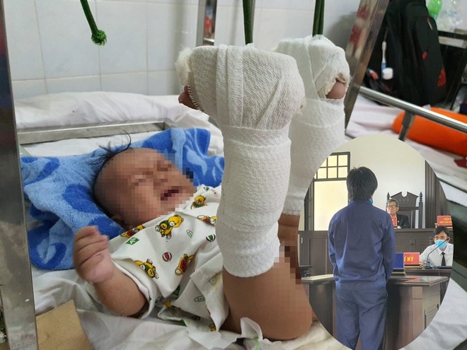 Cháu K. bị đánh gãy chân với nhiều thương tật trên cơ thể. Ảnh: TL.