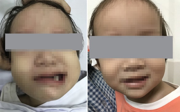 Hình ảnh bé B. đột ngột bị liệt mặt sau khi chảy mũi, ngạt mũi. Ảnh: tuoitre.vn