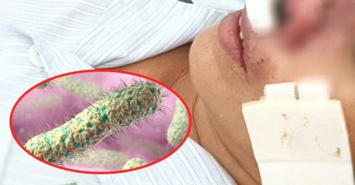 Bốn người chết do liên quan đến bệnh “vi khuẩn ăn thịt người” Whitmore. Ảnh: baogiaothong.vn