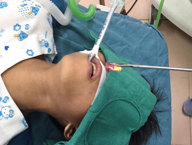 Hình ảnh viên thuốc còn cả vỏ được bác sĩ gắp ra từ thực quản bệnh nhi 10 tuổi. Ảnh: thanhnien.vn