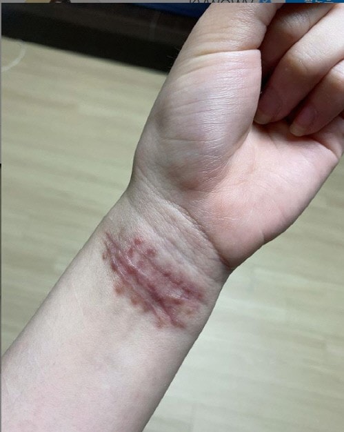 Những vết cắt chi chít trên cổ tay chứng tỏ Mina nhiều lần có ý định tự tử.