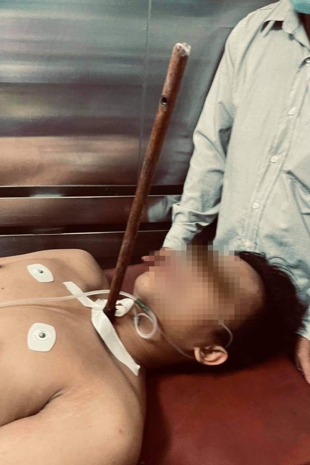 Bệnh nhân D. khi chuyển tới bệnh viện với cây tên (cây chĩa) còn xuyên cổ. Ảnh: dantri.com.vn