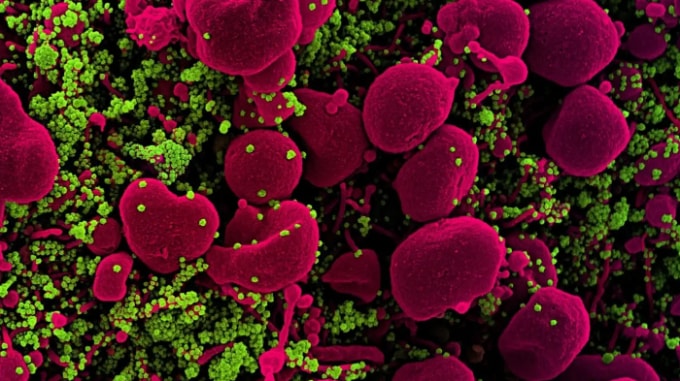 Tế bào bị nhiễm virus SARS-CoV-2. Ảnh: Nikkei