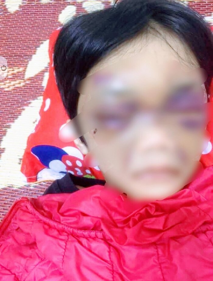 Cháu C. bị chính mẹ đẻ của mình là Vũ Thị Thủy bạo hành. Ảnh: baogiaothong.vn