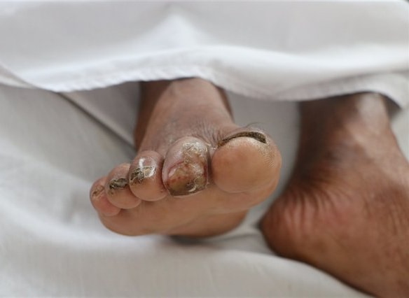 Một bệnh nhân bị vi khuẩn