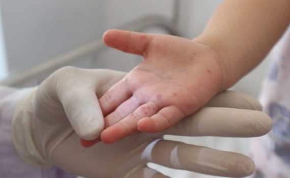 Bệnh tay chân miệng tăng cao tại các tỉnh phía Nam, 4 người đã tử vong. Ảnh minh họa