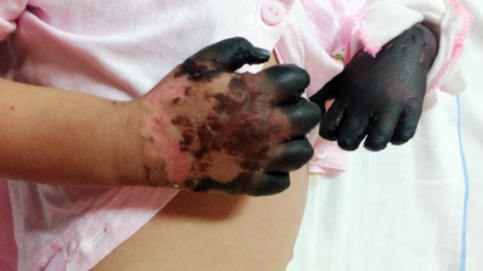 Bệnh than là bệnh truyền nhiễm lây truyền từ động vật sang người do vi khuẩn Bacillus anthracis gây ra . (Ảnh: Sở Y tế tỉnh Lào Cai cung cấp)