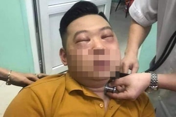 Nam thanh niên ở Phú Thọ gặp nguy kịch sau khi thái hành. (Ảnh: BVCC)