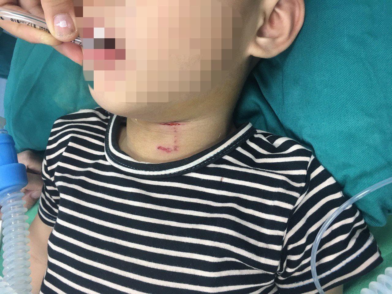 Hình ảnh cháu bé D.V.B. bị chó tấn công làm rách vùng cổ và thủng khí quản. Ảnh: tienphong.vn
