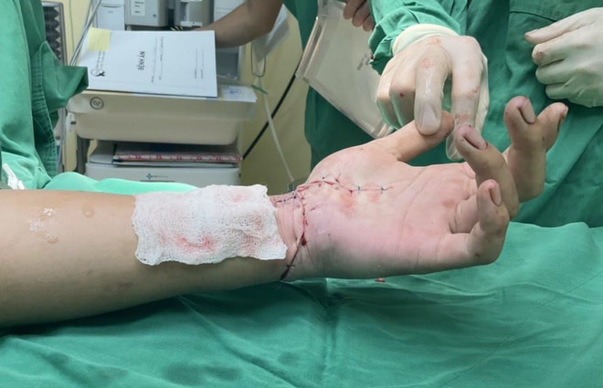tay ninh nam thanh nien bi dao tu che chem lia co tay trai hinh 2