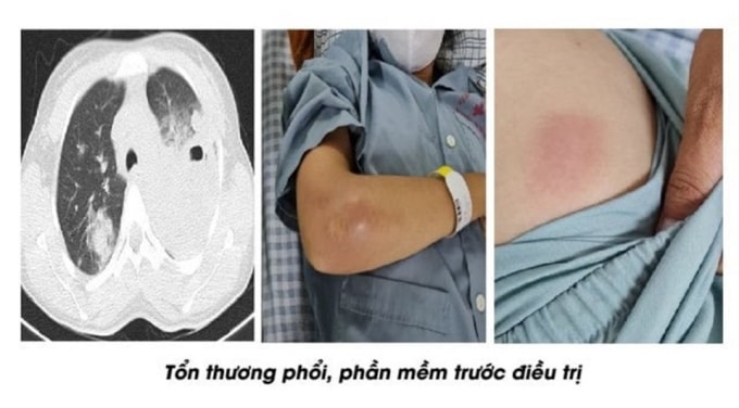 nu benh nhan o phu tho suyt mat mang do nhiem vi khuan an thit nguoi hinh 1