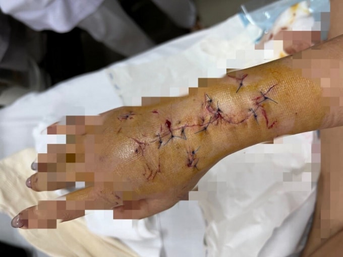 vu co gai bi hanh hung vi moi bia khong uong bi dut gan tai phai khau 15 mui hinh 2