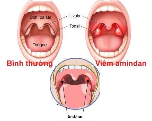 cac trieu chung cua viem amidan va cach xu ly hinh 1