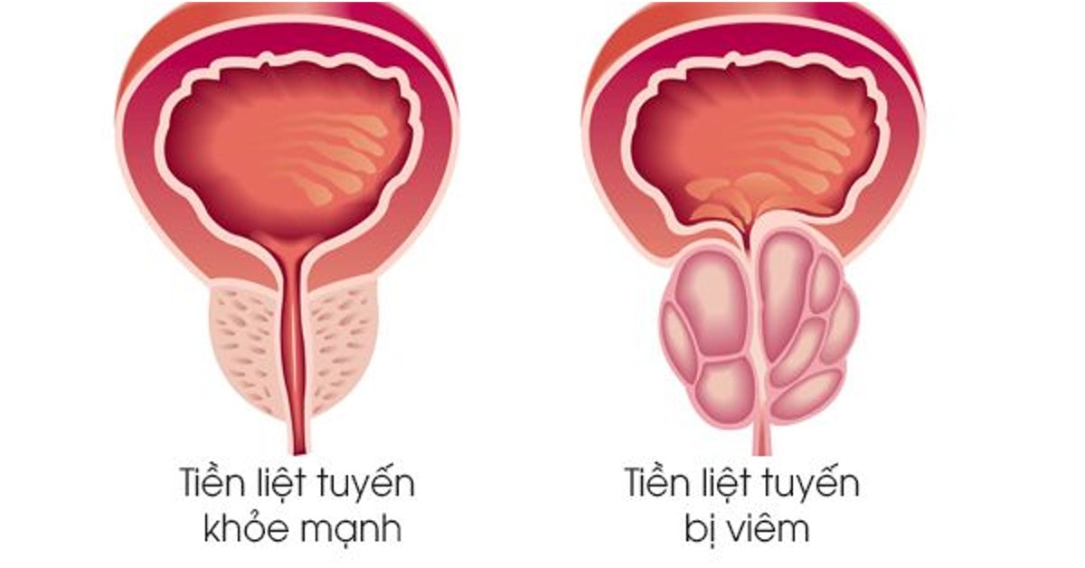 cach giam thieu nguy co mac benh viem tuyen liet tuyen o nam gioi hinh 1