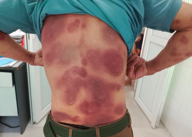 Tình trạng nhiễm độc toàn thân của bệnh nhân do tự ý dùng thuốc điều trị viêm gan B.