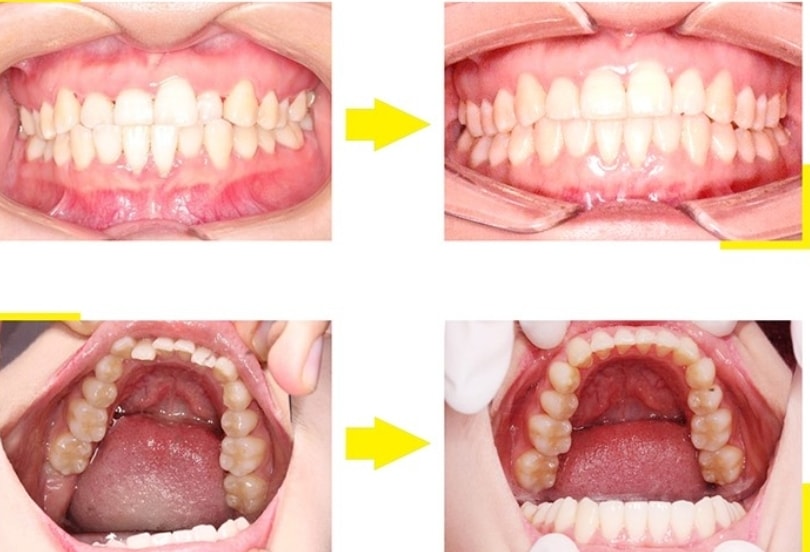 Hiệu quả thấy rõ sau khi niềng răng bằng VinciSmile.