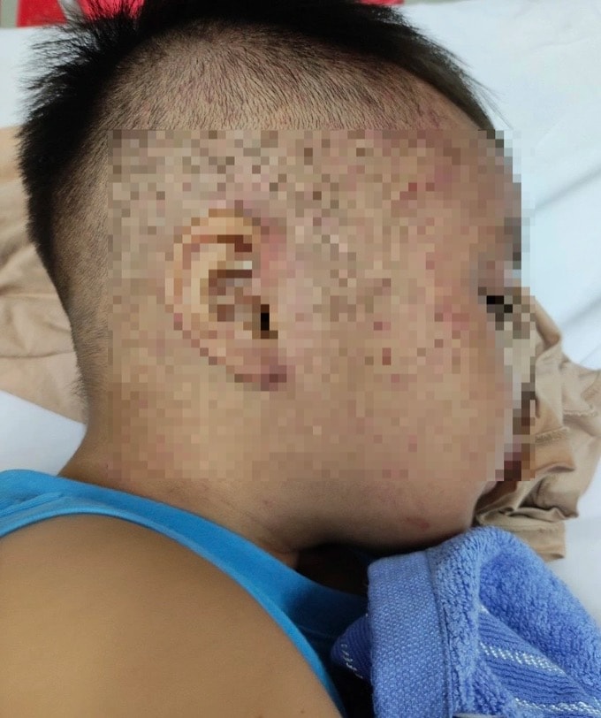 cap cuu kip thoi be trai 3 tuoi ruoi nghi bi bao hanh nhot trong tu cap dong hinh 1