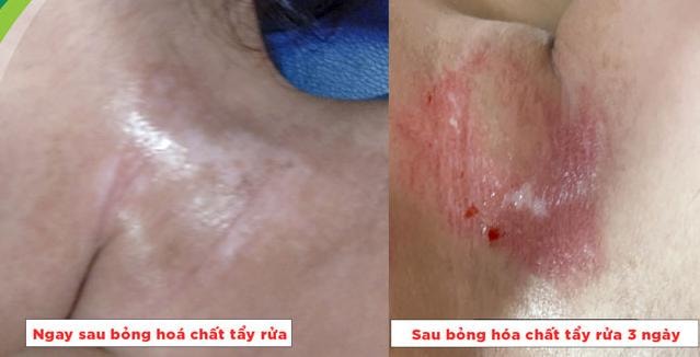 canh bao bibong do hoa chat tay dau mo hinh 1