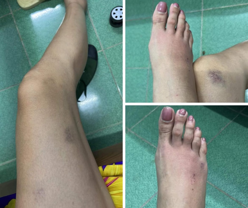 sieu mau hoang yen khien khan gia lo lang khi lo bi thoai hoa khop hinh 2