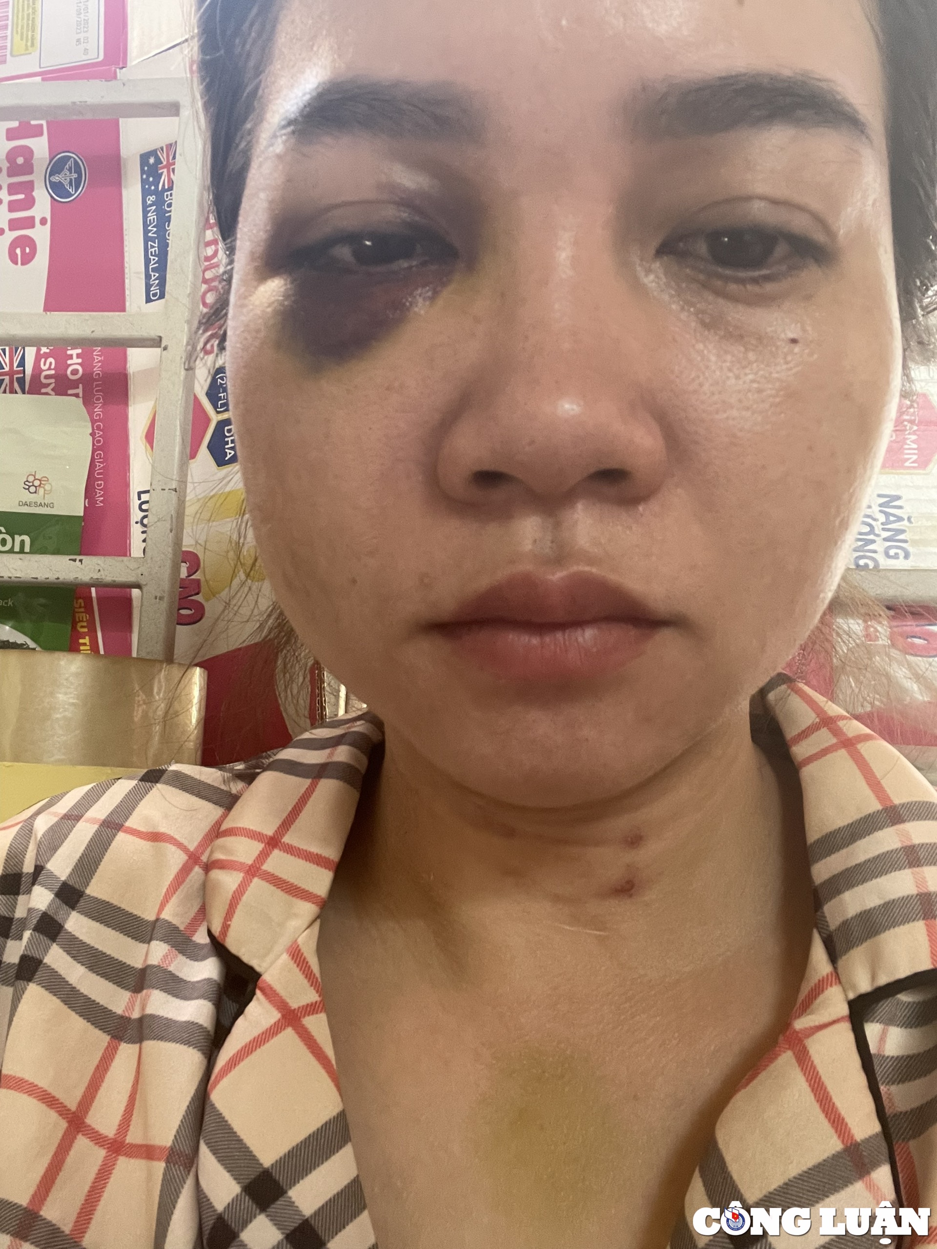 quang tri nguoi phu nu bi chong cu danh nhap vien khi den don con hinh 1