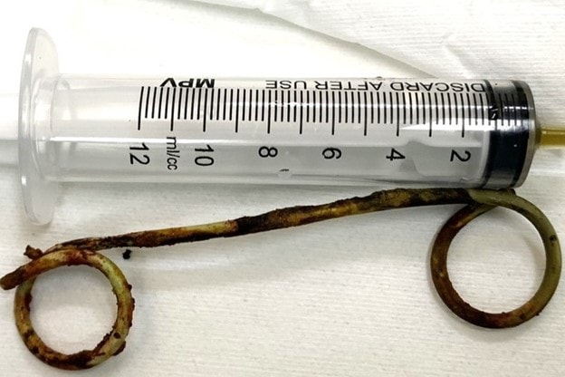 hy huu stent dai 15cm bi bo quen trong ong mat cua cu ba suot 6 nam hinh 1